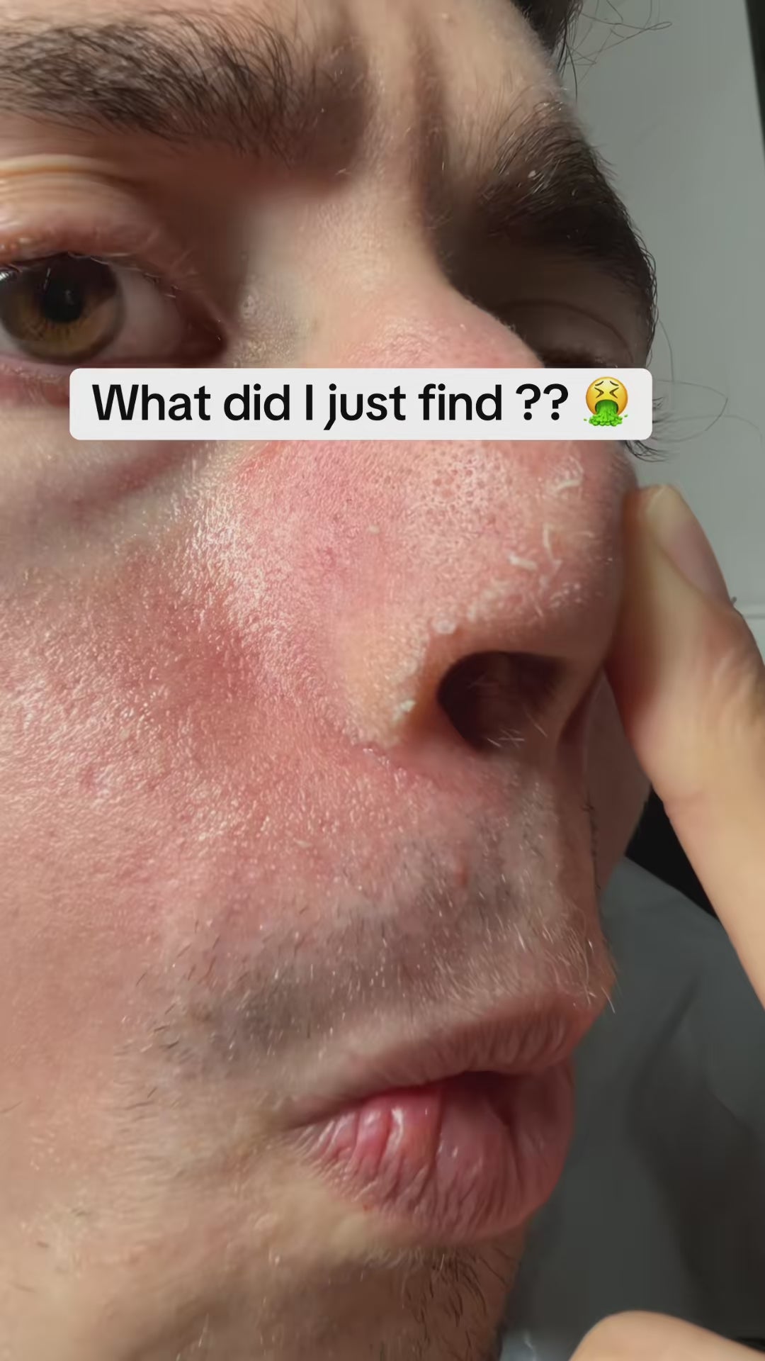 Dr.Melaxin - Peel Shot Duo Bundle Set video